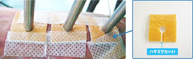 イリザロフ創外固定術のピン刺入部の保護例画像